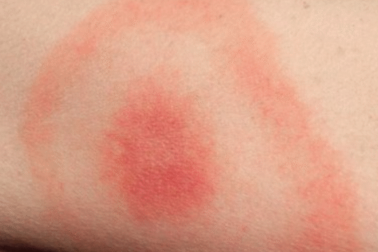 A red circular rash on a person's leg with a central spot.